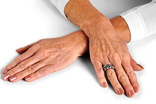 회춘 기술의 사용이 필요한 노화 관련 변화가 있는 손 피부